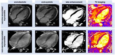 Cardiovascular magnetic resonance imaging patterns of acute COVID-19 mRNA vaccine-associated myocarditis in young male patients: A first single-center experience